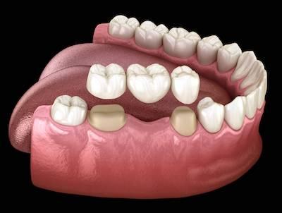An illustration of dental bridges in sterling, co
