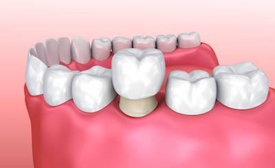 A model of a dental crown at Pradera dental in Sterling, CO..