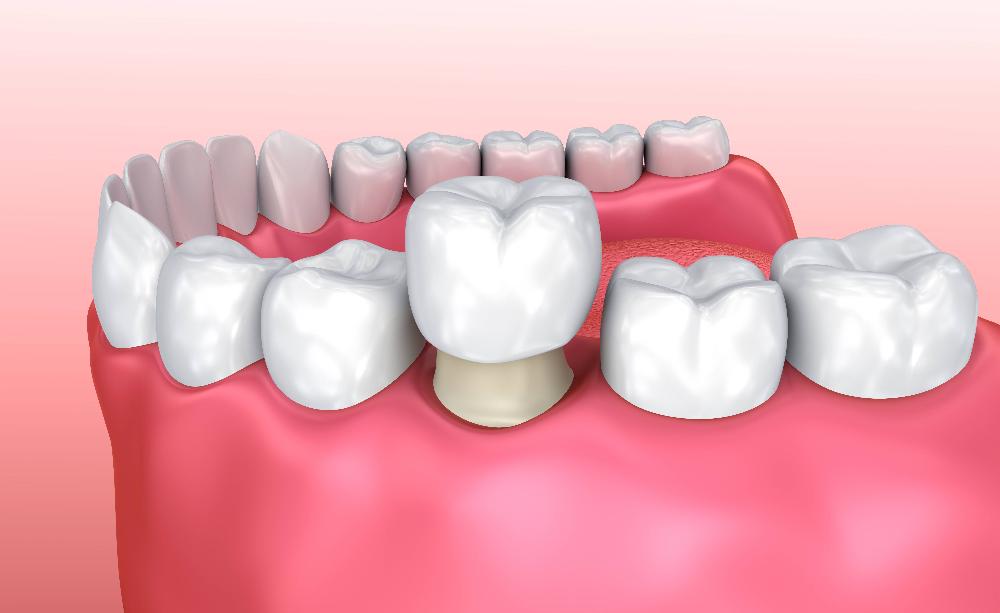 An illustration of dental Crown and bridges in Sterling, CO 