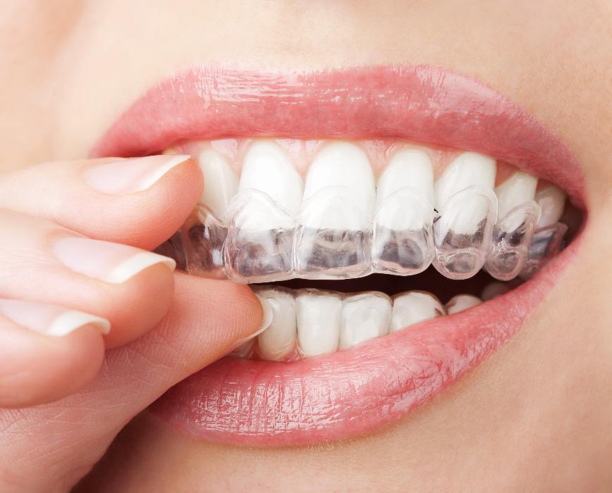 Lady putting clear aligners on her teeth at Pradera Dental