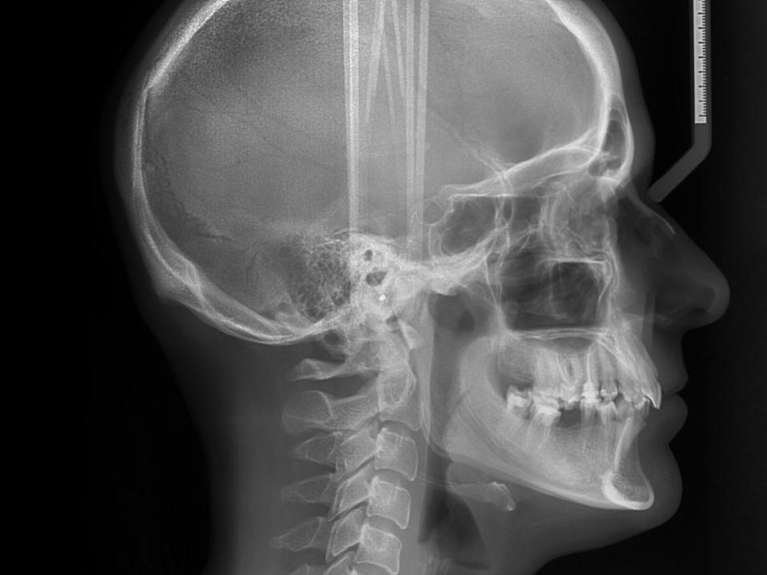 A Cephalometric X-Ray picture of the head at Pradera Dental